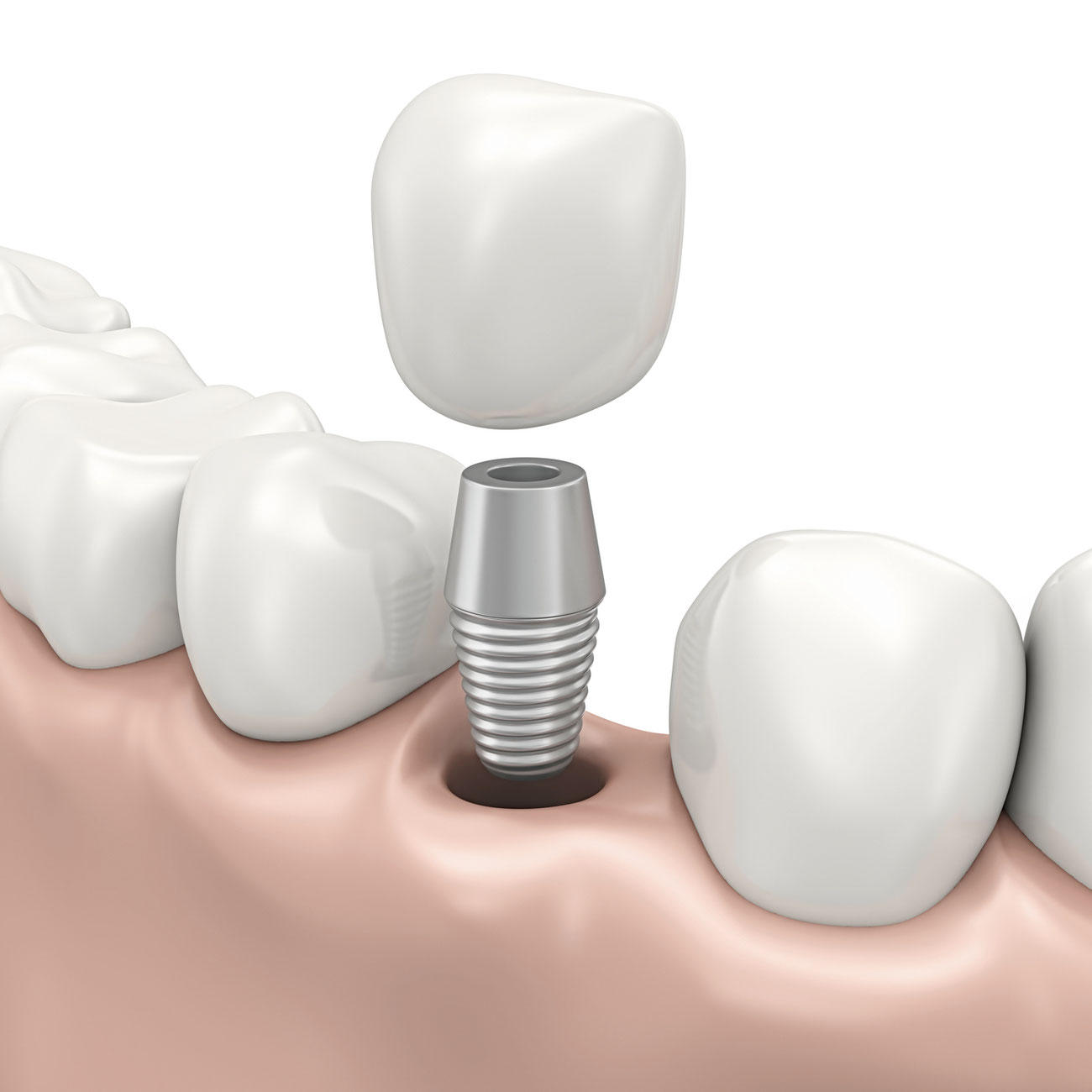 Implantate